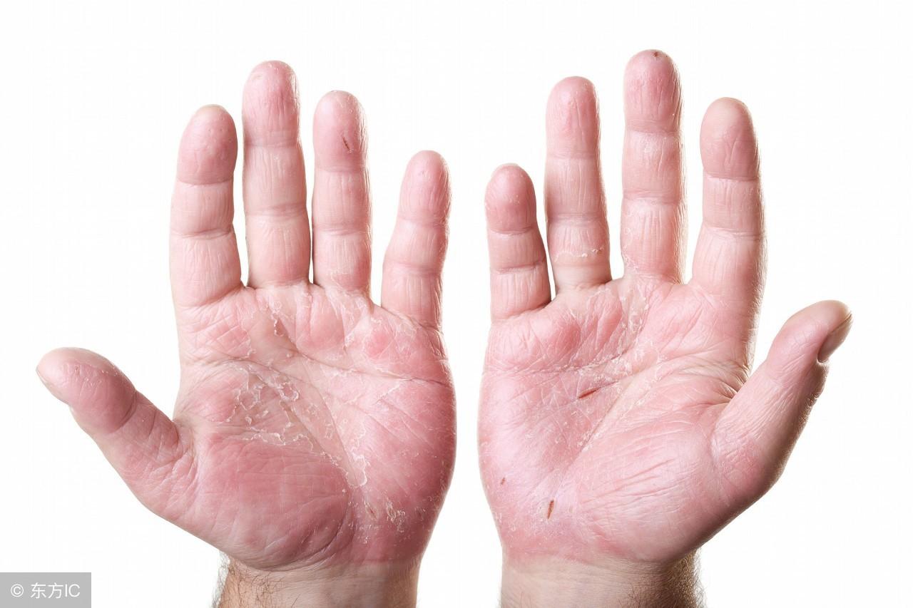 濕疹怎么治療，全面解析有效的治療方法，全面解析濕疹的有效治療方法