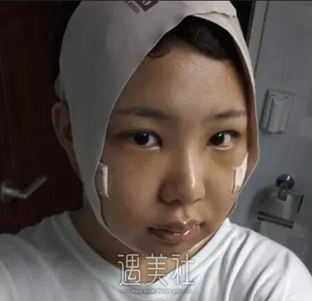 磨骨一年后的驚人變化，對(duì)比照片揭示細(xì)節(jié)，磨骨一年后的驚人變化，細(xì)節(jié)對(duì)比揭示驚人效果