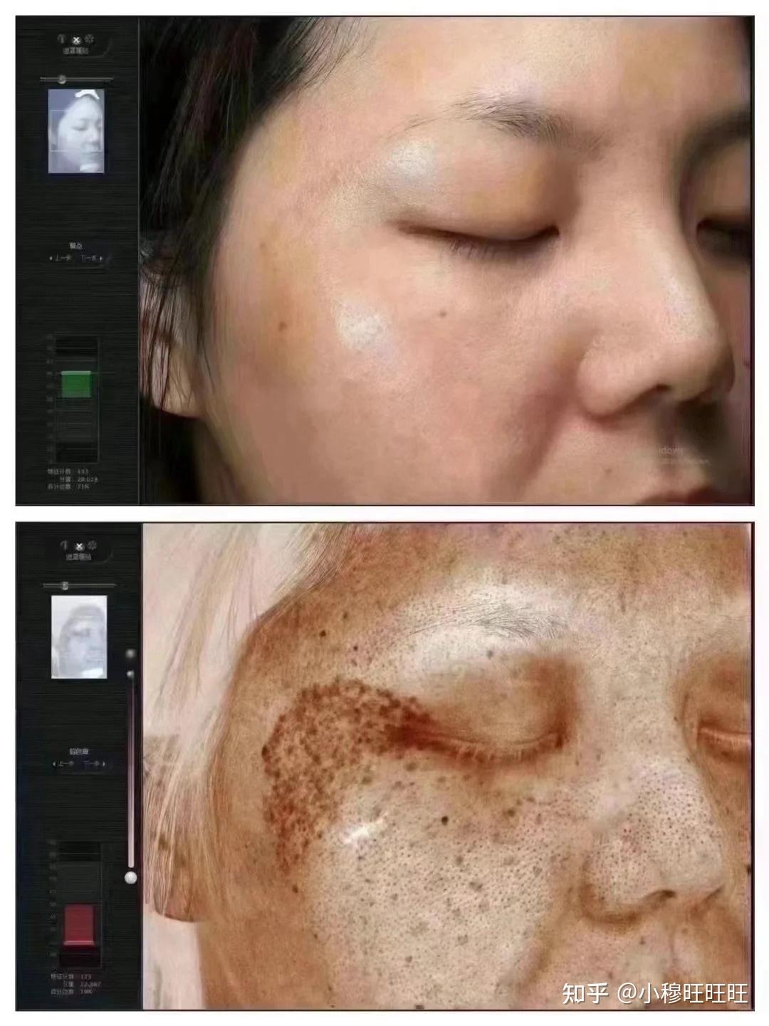 激光祛斑，選擇醫(yī)院還是美容院？全面解讀助您做出明智決策，激光祛斑，如何選擇醫(yī)院與美容院？全面解讀為您指明決策方向