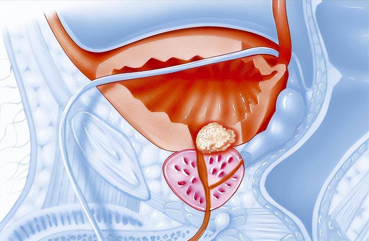 前列腺炎拖久了會(huì)怎樣，前列腺炎拖久了的后果，嚴(yán)重并發(fā)癥與影響生活質(zhì)量