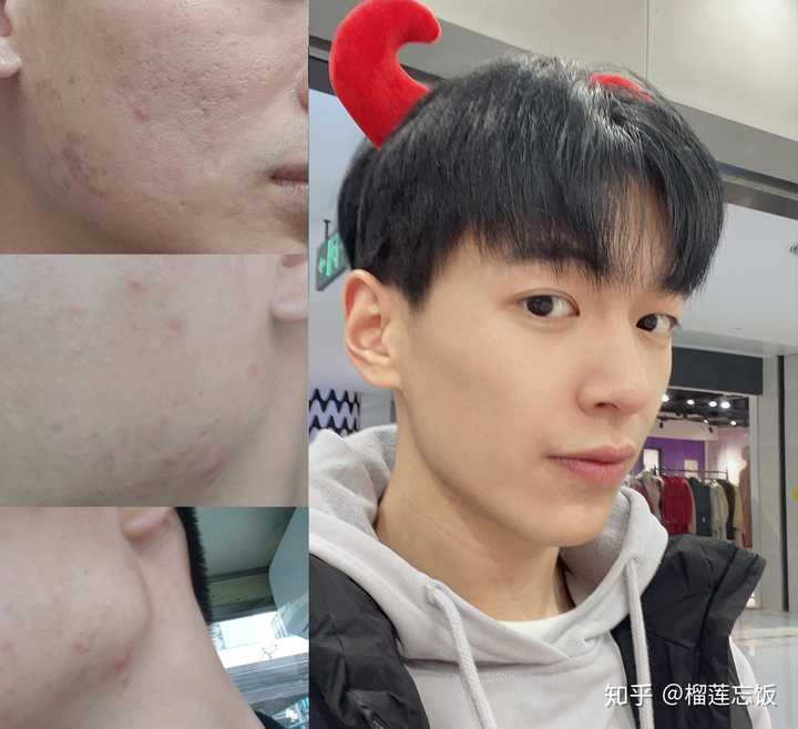 如何有效去除臉上的痘印——全方位指南，全方位指南，如何有效去除臉上痘印的方法