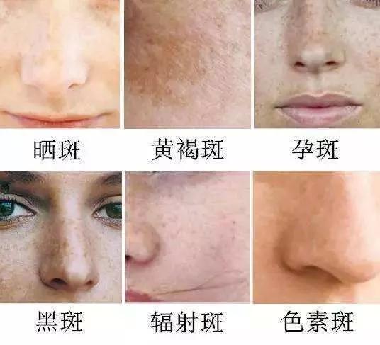 如何有效去除臉上斑點——全方位指南，全方位指南，如何有效去除臉上斑點