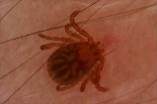 蜱蟲(chóng)咬人后的癥狀及應(yīng)對(duì)措施，蜱蟲(chóng)咬人后的癥狀與應(yīng)對(duì)措施解析