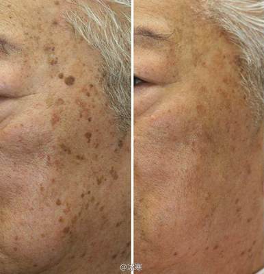 如何有效去除老年斑——全面解析，全面解析，有效去除老年斑的方法