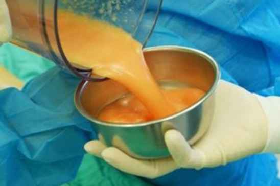 雙下巴抽脂手術費用詳解，價格因素與預算參考，雙下巴抽脂手術費用解析，預算參考與價格因素探討