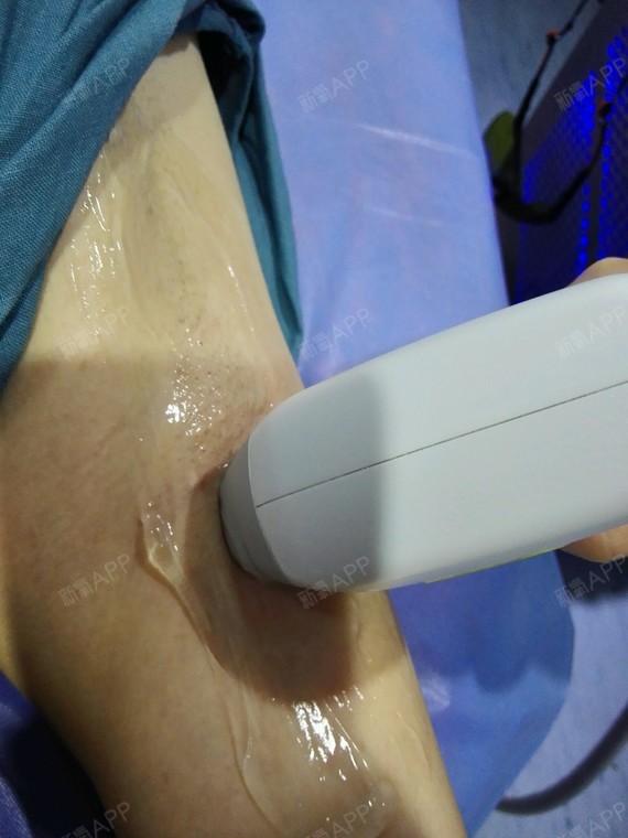 激光脫毛，疼痛感受與體驗(yàn)解析，激光脫毛，疼痛感受與體驗(yàn)詳解