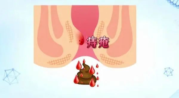 大便出血，痔瘡還是肛裂？一篇文章帶你了解，大便出血，痔瘡還是肛裂？一篇文章全面解析
