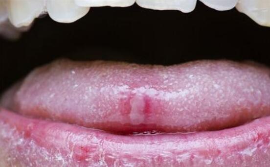 口腔粘膜炎癥，深入了解與治療策略，口腔粘膜炎癥，全面解析與治療指南