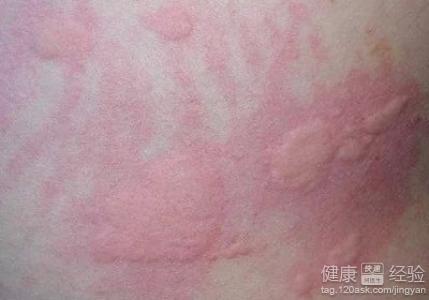 風(fēng)疹是怎么引起的，風(fēng)疹的成因解析